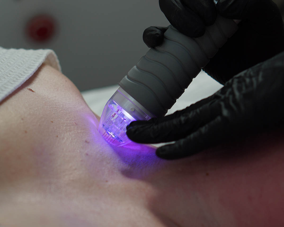 Микроигольчатый RF-лифтинг (VIVACE) — лицо